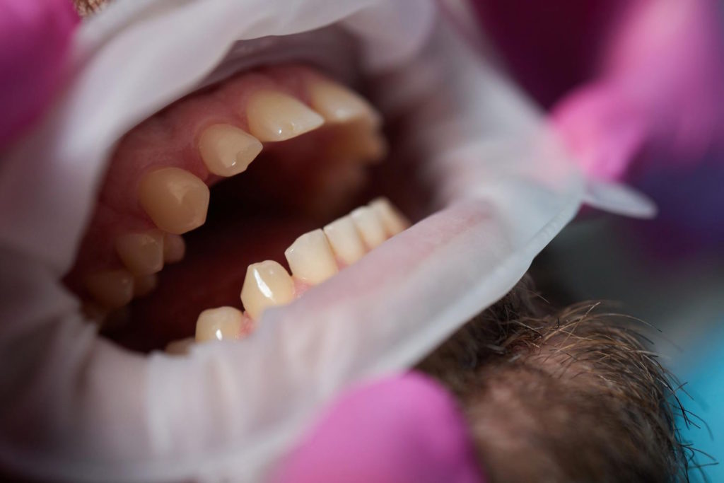 Leczenie kanałowe jest jednym z najważniejszych zabiegów w stomatologii, które pozwala uratować zęby przed usunięciem